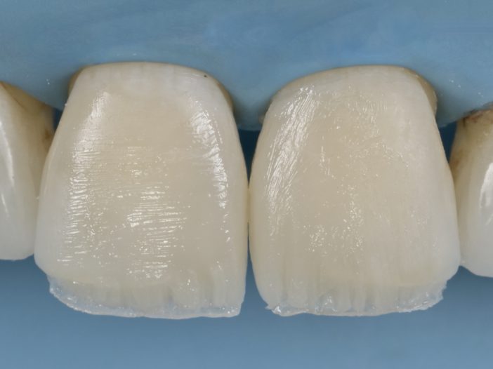 Foto 3. centrale incisieven dentine